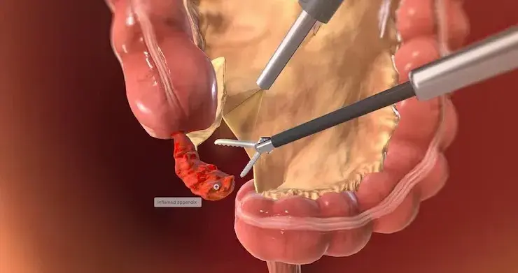 Laparoscopic Appendicectomy