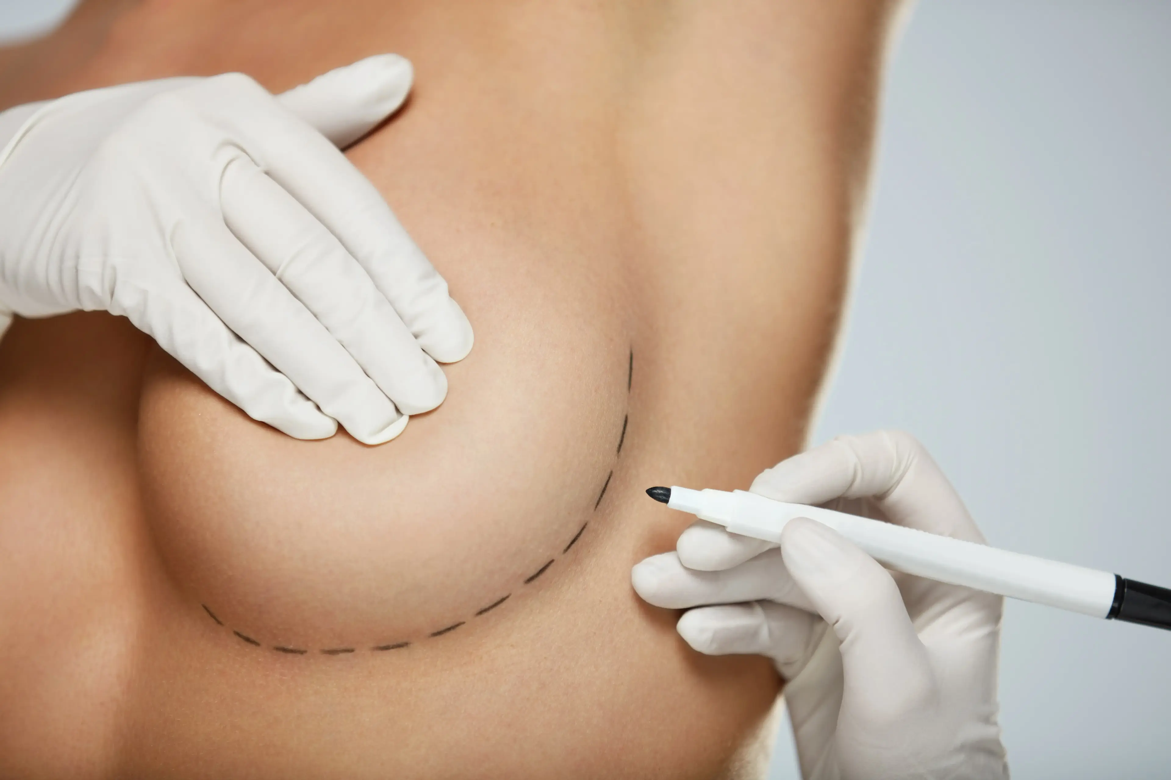 Breast Surgery