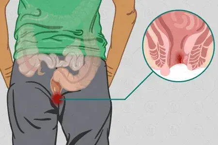 Fissure, Fistula & Hemorrhoids Treatment